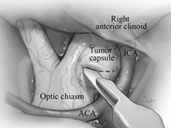 Pterional Craniotomy for Clinoidal Meningioma